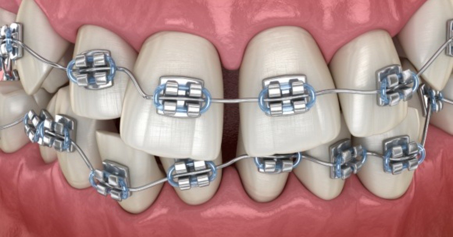 Orthodontics & Smile Designing